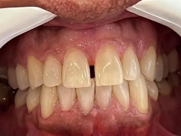 Antes - tratamento Invisalign para diastema