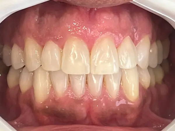 Depois - tratamento Invisalign para diastema