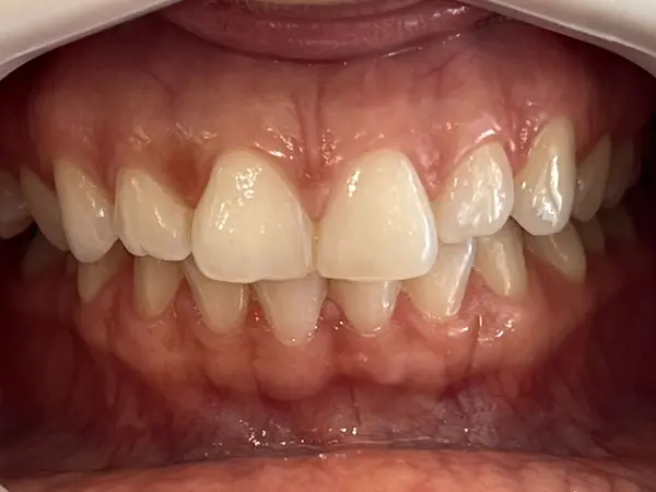 Antes - tratamento Invisalign alinhamento leve