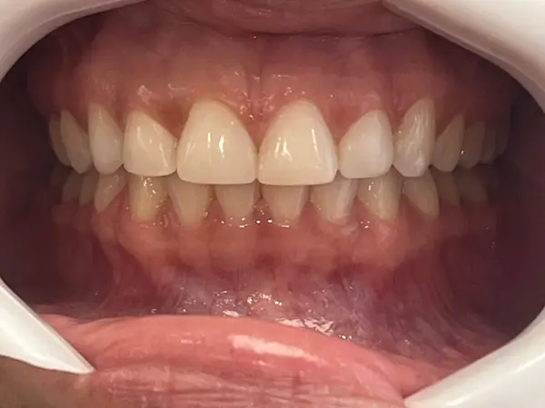 Depois - tratamento Invisalign alinhamento leve