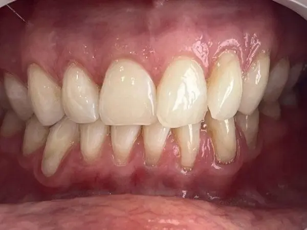 Antes - tratamento Invisalign apinhamento moderado