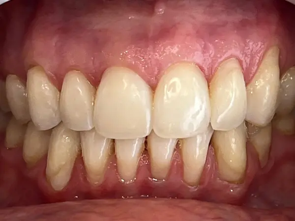 Depois - tratamento Invisalign apinhamento moderado